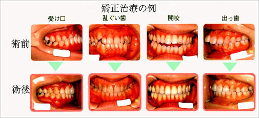 矯正治療の例