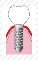 インプラント画像